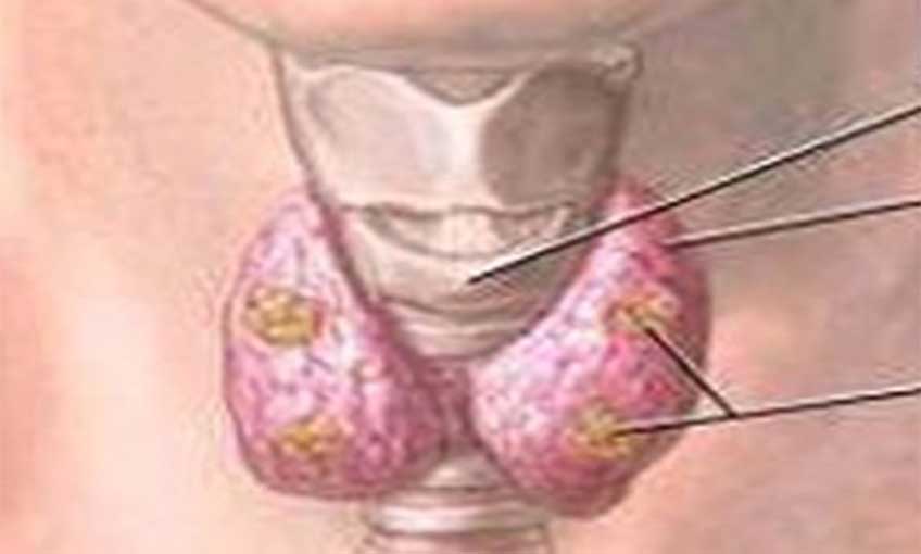 Her iki kişiden birinde tiroit nodülü bulunuyor