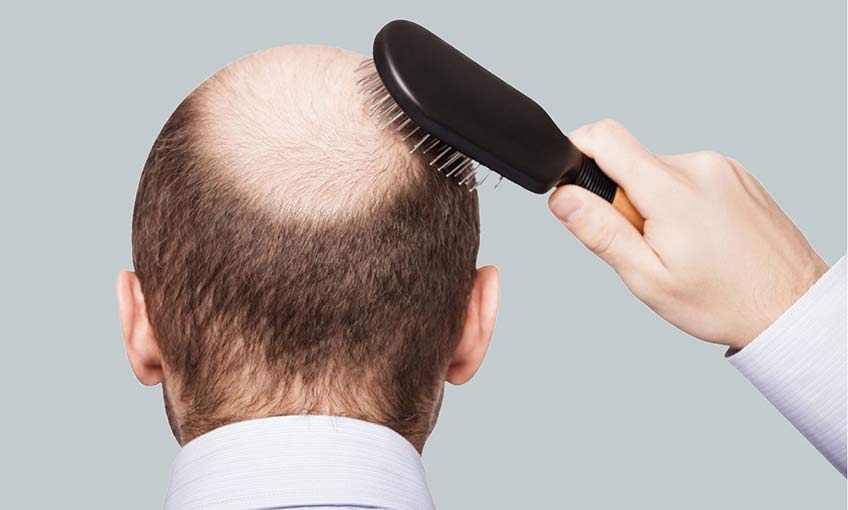 Saç ekimi sonrası hayata daha mutlu bakın