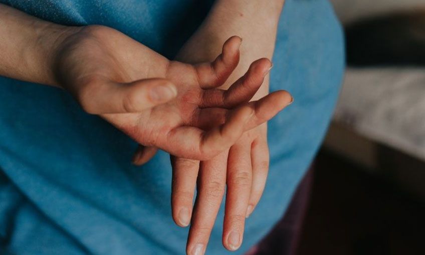 Bağışıklık Sistemine Bağlı Olarak Oluşan Deri Sertleşmeleri: Skleroderma